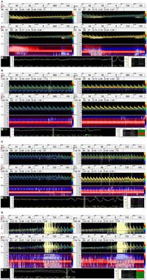 Comparison of Unilateral Middle Cerebral Artery and Bilateral Middle Cerebral Artery Monitoring for Right-to-Left Shunt Detection by Contrast-Enhanced Transcranial Doppler